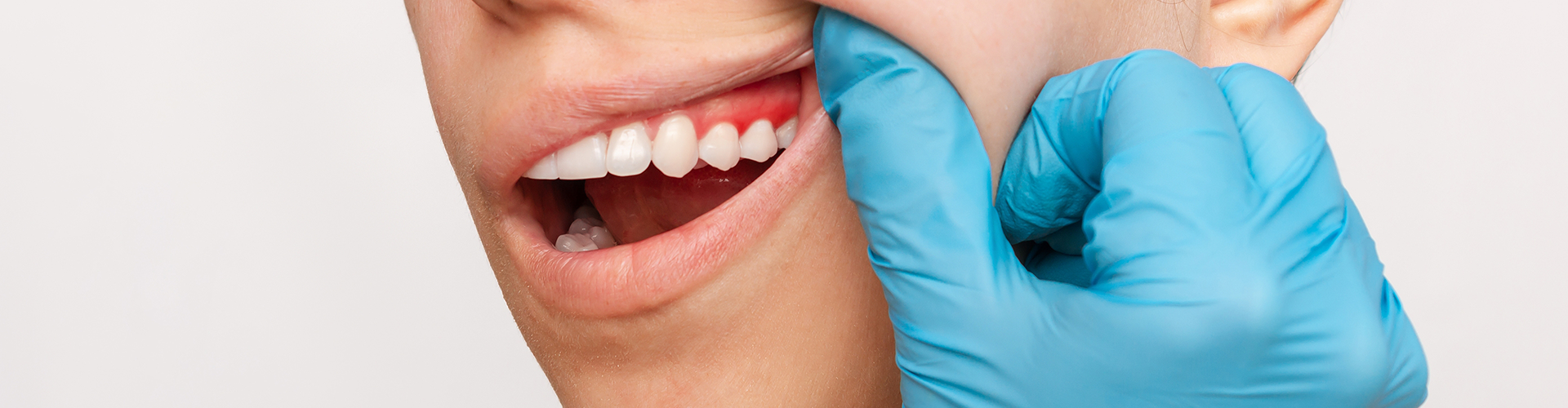 woman raising lip to reveal inflamed gums.